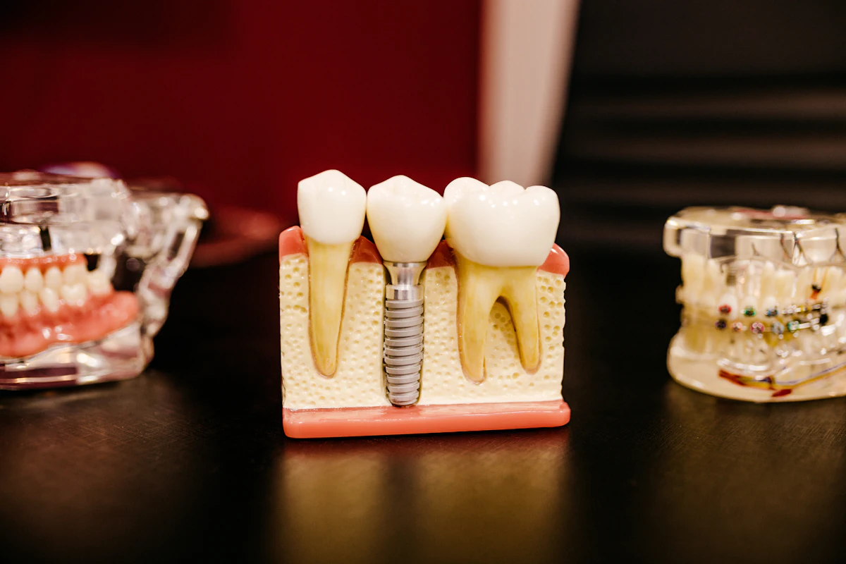 Model de implant dentar cu coroană